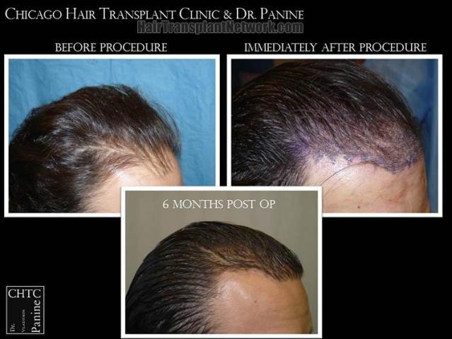 Hair transplantation surgery before and after images