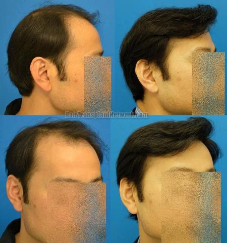 Hair transplantation surgery before and after images