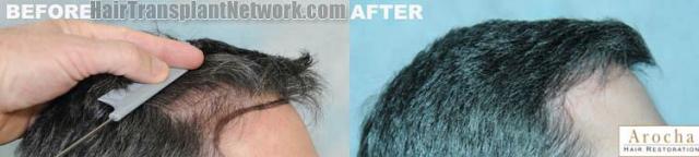 Hair transplantation surgery before and after photos