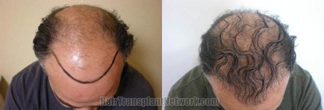 Hair transplantation surgery before and after photos