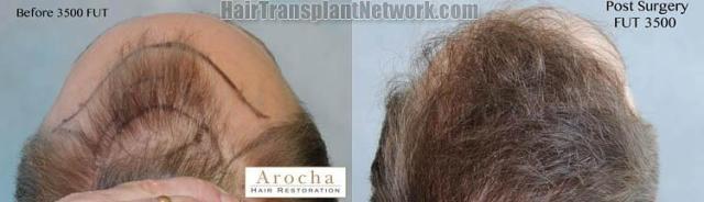 Hair transplantation surgery before and after pictures