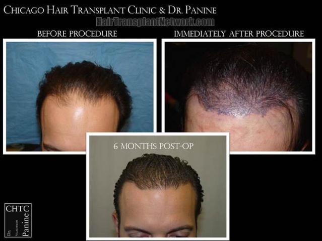 Hair restoration procedure before and after results