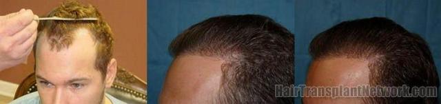 Hair restoration procedure results