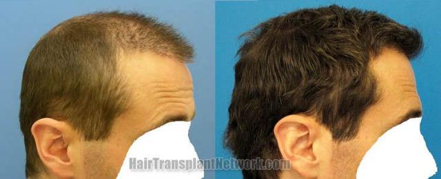 Right view before and after hair restoration