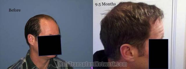 Right view before and after hair restoration procedure