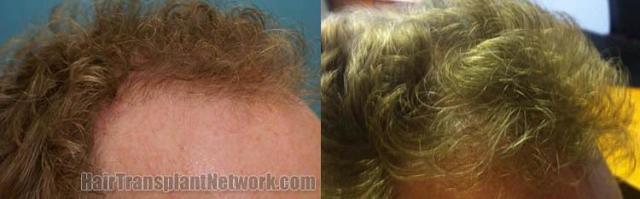 Hair restoration procedure before and after results