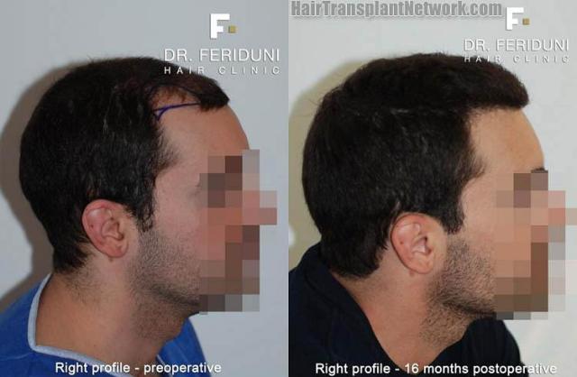 Hair restoration procedure before and after results