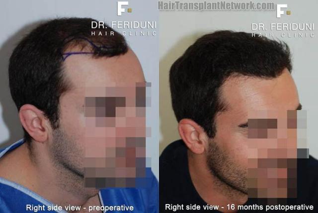 Hair transplantation surgery before and after pictures