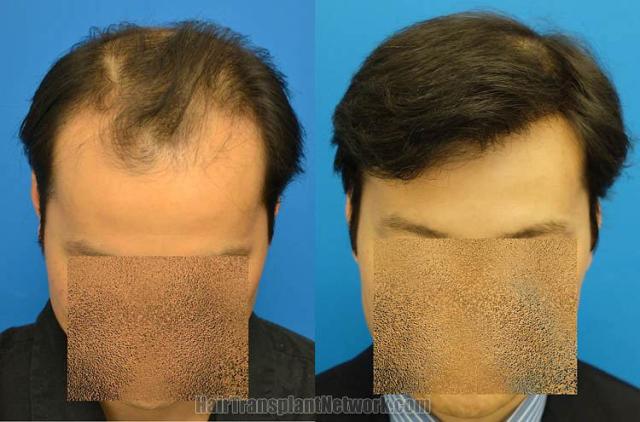 Hair restoration procedure before and after pictures