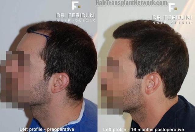 Hair transplantation surgery before and after photos