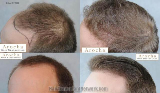 Hair transplantation surgery before and after images