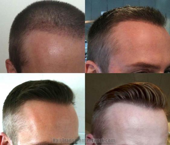 Hair transplantation surgery before and after images