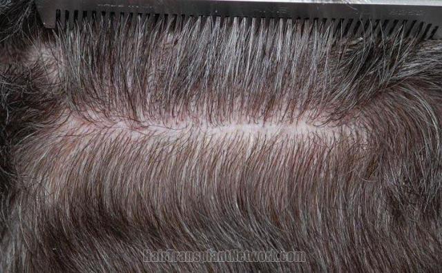 Residual scar from hair transplant patient donor area