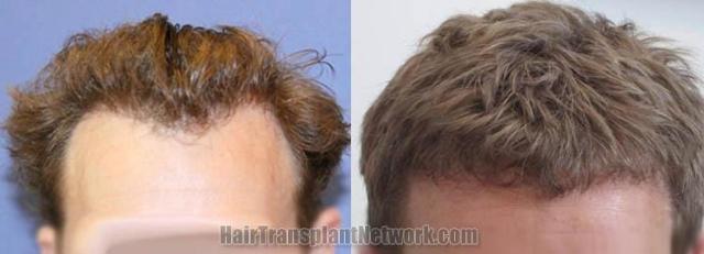 Hair restoration procedure before and after results