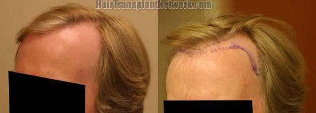 Before and after surgical hair restoration images