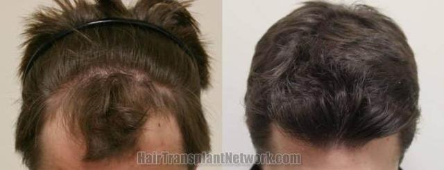 Top view before and after hair restoration results