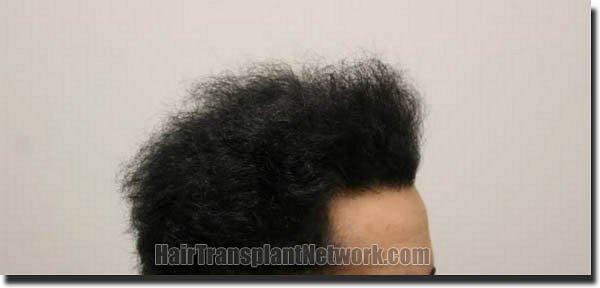 Hair restoration procedure results