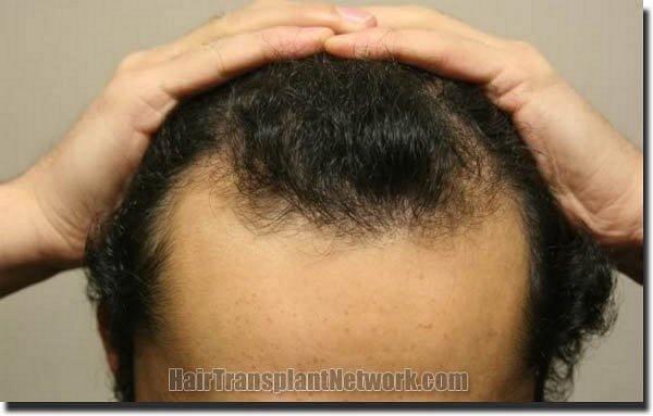 Hair restoration procedure results