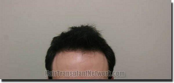 Hair restoration procedure results