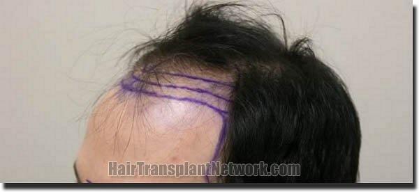 Hair restoration procedure results