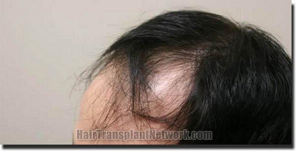 Hair restoration procedure results