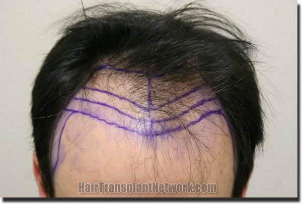 Hair restoration procedure results