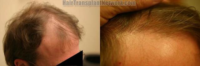 Hair transplantation surgery before and after images