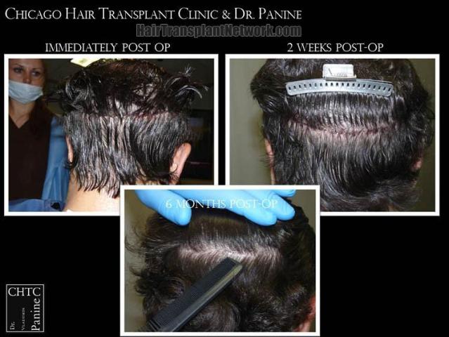 Hair restoration procedure before and after pictures