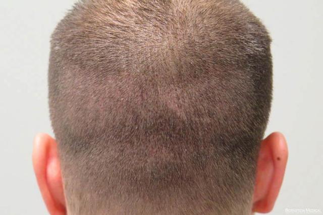 Hair transplant procedure before and after images