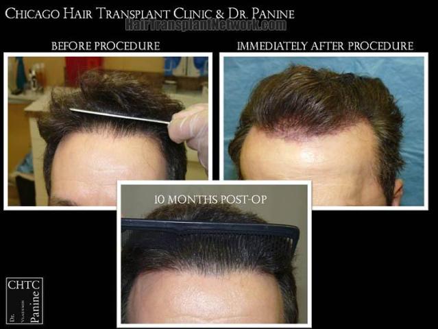 Hair restoration procedure before and after results