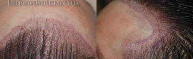 Hair transplantation surgery before and after pictures