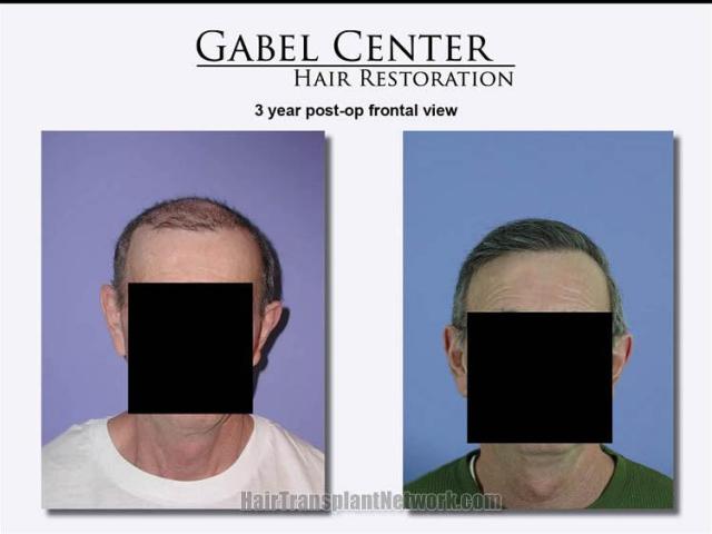Front view before and after hair transplant results