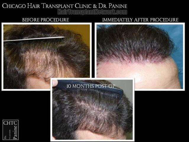 Hair transplantation surgery before and after pictures