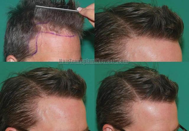 Hair transplantation surgery before and after photos