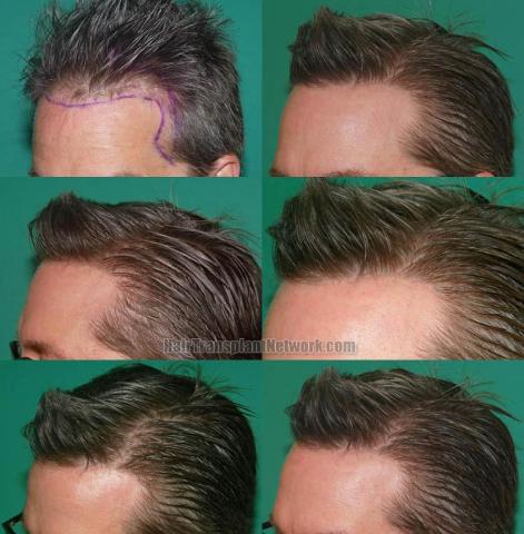 Hair transplantation surgery before and after images