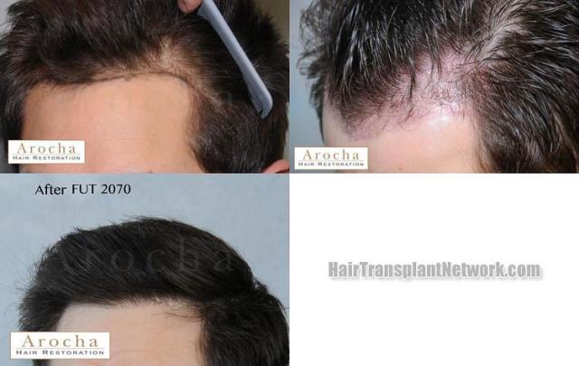 Hair transplantation surgery before and after pictures