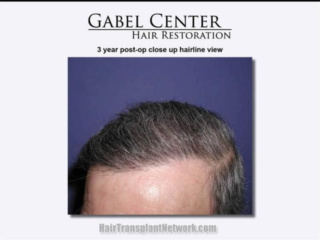 Left closeup view three years postoperative from hair transplant