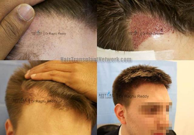 Hair restoration procedure before and after pictures