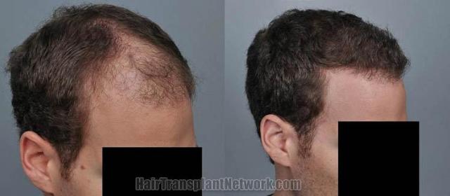 Hair transplantation surgery before and after photos