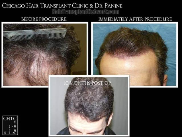 Hair restoration procedure before and after results