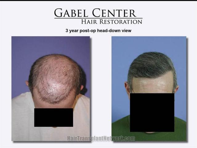 Top view before and after hair transplant repair