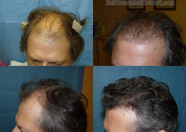 Hair restoration procedure results