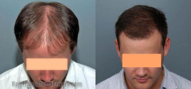 Hair restoration procedure results