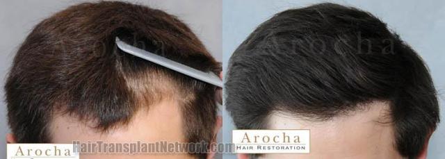 Hair transplantation surgery before and after images