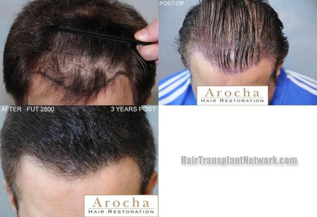 Hair transplantation surgery before and after photos