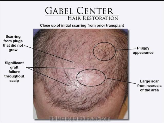 Initial hair transplant evaluation before surgery
