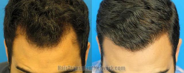 Top view before and after hair restoration results