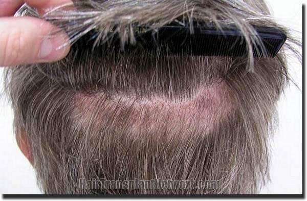 Hair restoration procedure results