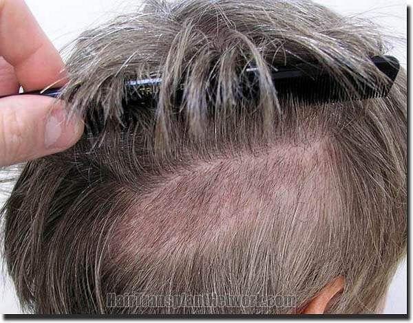 Hair restoration procedure results