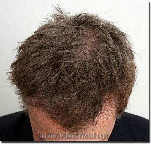 Hair restoration procedure results